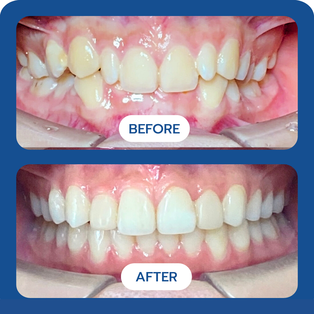 Invisalign Before and After Case 5